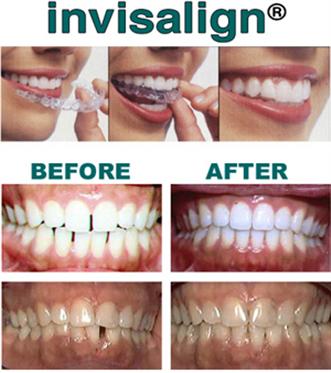 Invisalign Lawndale CA, Clear Braces, Straighten Teeth