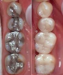Before and after the placement of tooth-colored fillings