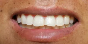 Before dental bonding