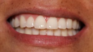 After dental bonding