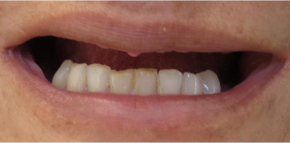 Implants and Zirconia Crowns 1 