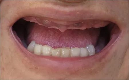 Implants and Zirconia Crowns 2