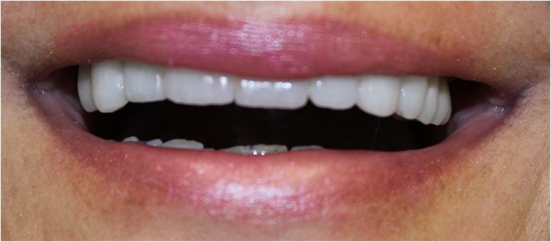 Implants and Zirconia Crowns 3 