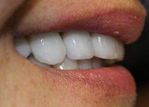 Implants and Zirconia Crowns 4