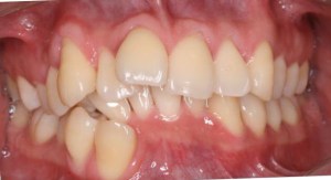 Before orthodontic treatment patient photo