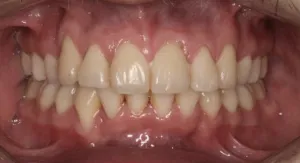 After orthodontic treatment patient photo