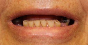 Photos of Patient with all Upper Jaw Implants & Porcelain fused to Gold Bridges1