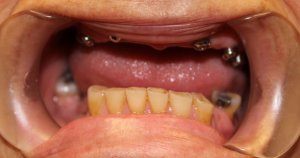 Photos of Patient with all Upper Jaw Implants & Porcelain fused to Gold Bridges 2