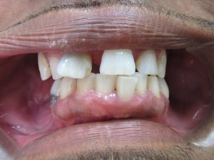 Patient before photo of upper teeth and lower back teeth