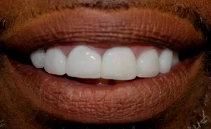 Patient photo showing full restoration of upper and lower back teeth