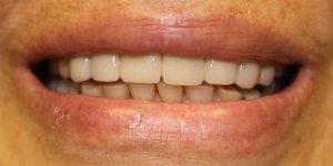 Photos of Patient with all Upper Jaw Implants & Porcelain fused to Gold Bridges- final