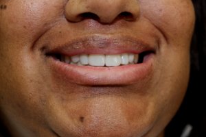 Ebony - Veneers & Implants after 2