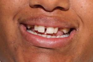 ebony - Veneers & Implants after