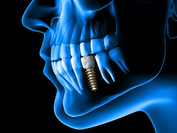 jaw xray