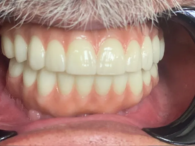 Implant-retained full upper denture