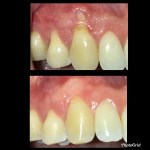 Chipped upper central incisor, adjacent discoloration, and inflamed gingiva. After: Smooth composite or ceramic restoration with natural translucency and healthy tissue