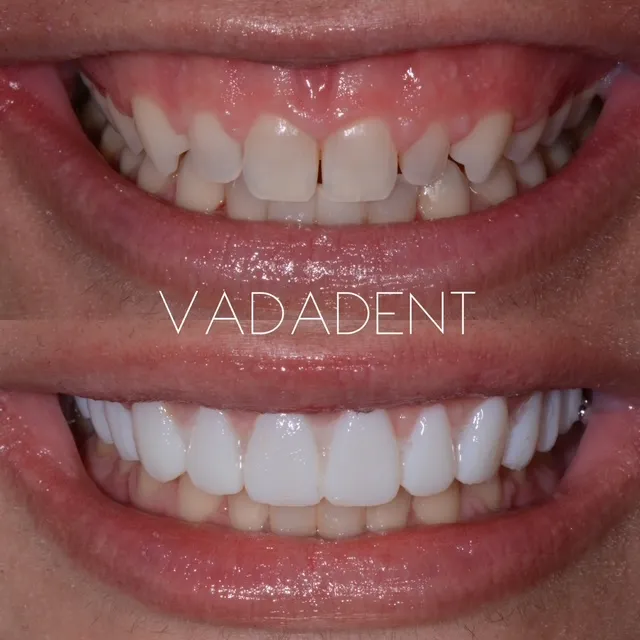 Before: Crowded, rotated upper incisors with mild wear. After: Aligned, uniform smile with minimal-prep veneers
