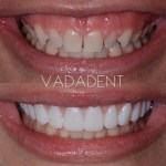 Before: Crowded, rotated upper incisors with mild wear. After: Aligned, uniform smile with minimal-prep veneers