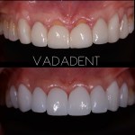 Before: Uneven, discolored upper anterior teeth with midline deviation. After: Harmonious smile with bonded porcelain veneers; balanced shade, length, and emergence profile