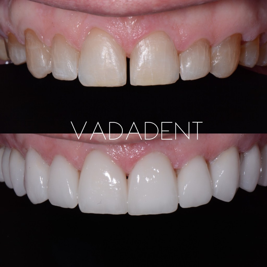Discolored, uneven upper anterior teeth with midline diastema. After: Bright, symmetrical smile with porcelain veneers