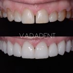 Discolored, uneven upper anterior teeth with midline diastema. After: Bright, symmetrical smile with porcelain veneers