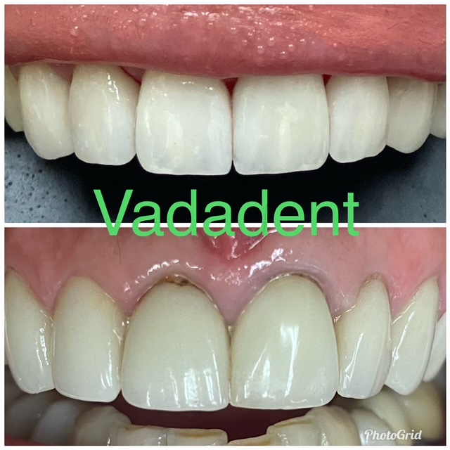 Upper anterior teeth with discoloration, uneven incisal edges, and mild gingival recession. After: Restored teeth with natural-shade porcelain veneers; improved symmetry and contour