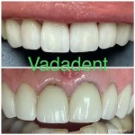 Upper anterior teeth with discoloration, uneven incisal edges, and mild gingival recession. After: Restored teeth with natural-shade porcelain veneers; improved symmetry and contour