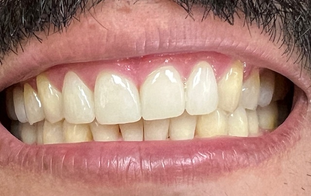 Upper Teeth Crowns and Gum Surgery