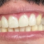 Upper Teeth Crowns and Gum Surgery