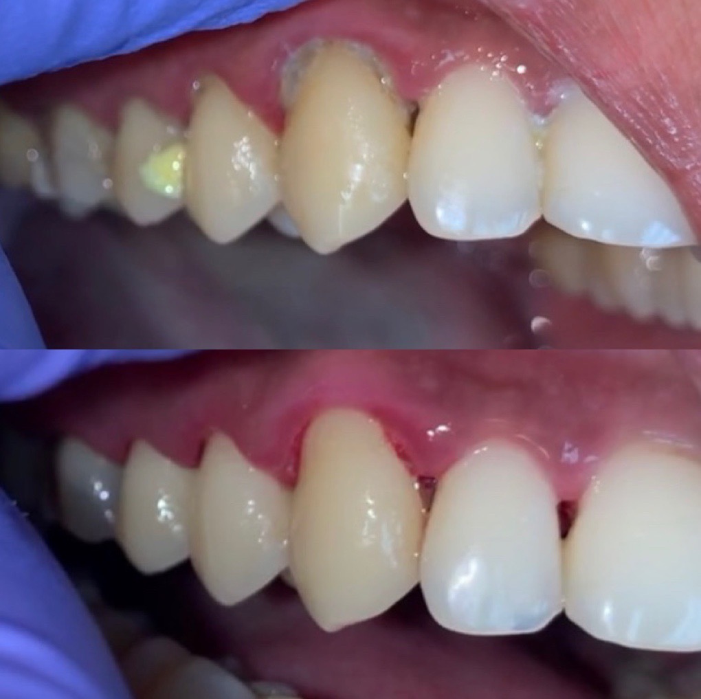 Carious lesion on upper right lateral incisor + gingival inflammation. After: Restored tooth with seamless composite or ceramic bonding; healthy gums