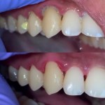 Carious lesion on upper right lateral incisor + gingival inflammation. After: Restored tooth with seamless composite or ceramic bonding; healthy gums