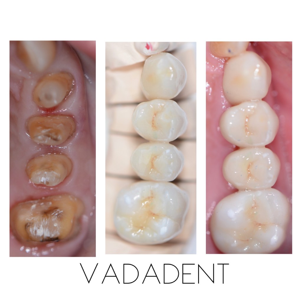 Carious lesions on posterior teeth. Center: Diagnostic wax-up showing proposed crown contours. Right: Final ceramic crowns seated with proper occlusion 