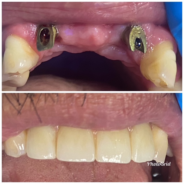 before and after Posterior teeth bonding