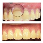Before: Upper left lateral incisor with hypocalcification (white spot lesion) and mild enamel irregularity — pre-treatment. After: Same tooth after microabrasion or resin infiltration: reduced opacity, improved surface smoothness and shade harmony.